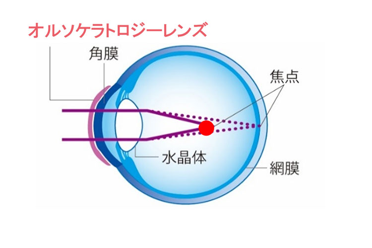 夜：レンズ装用中